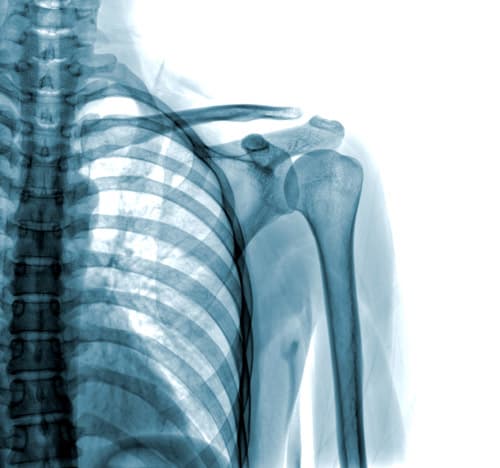 Shoulder arthroscopy