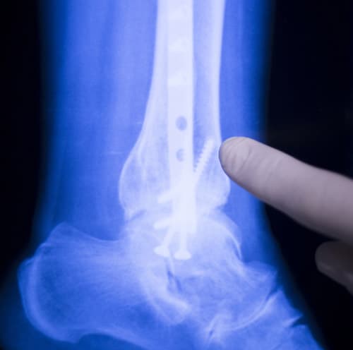 Ankle ligament reconstruction