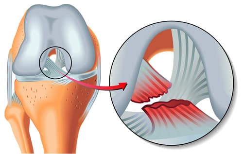 Knee ligament reconstruction